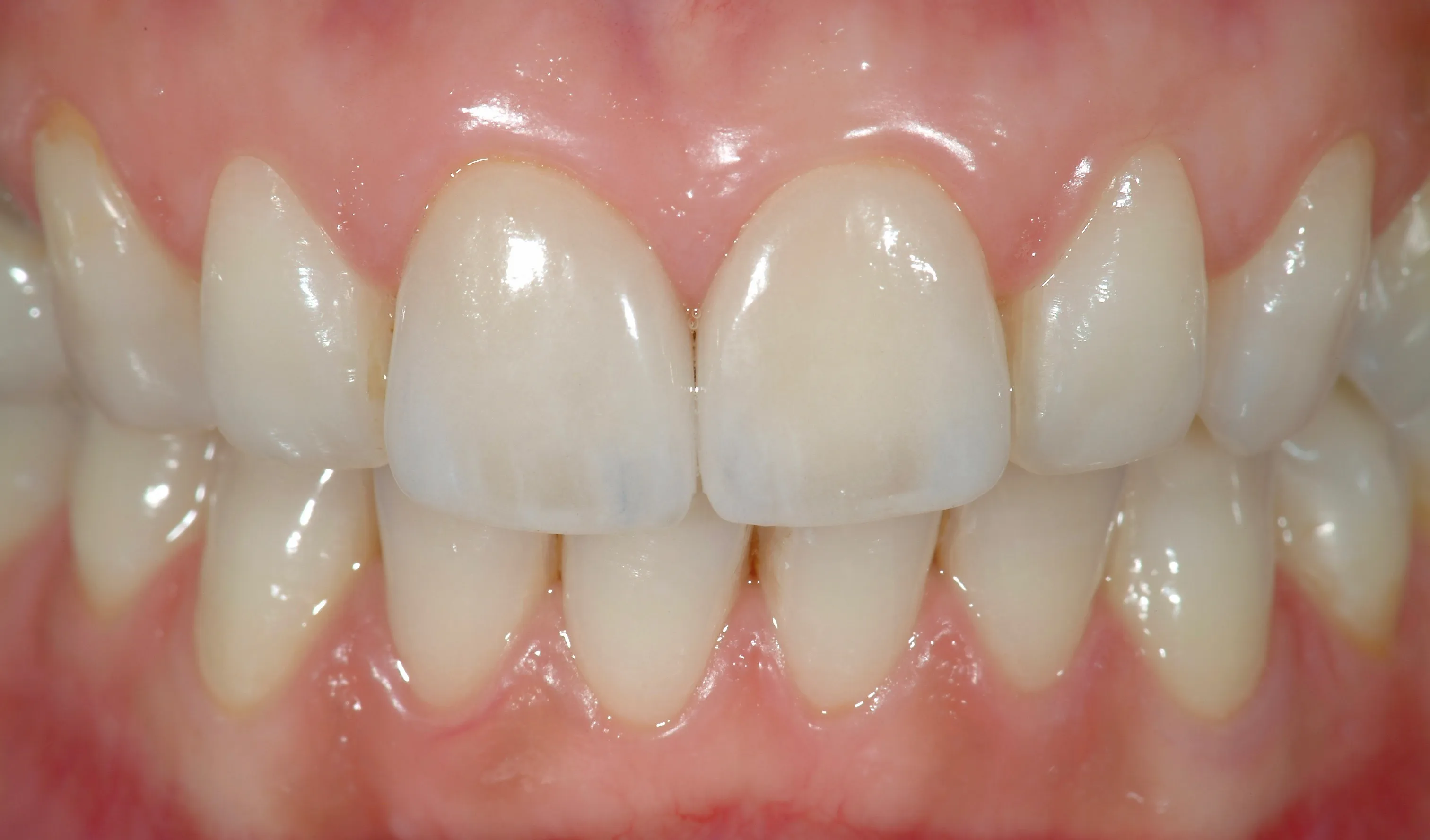 Restyling degli incisivi centrali