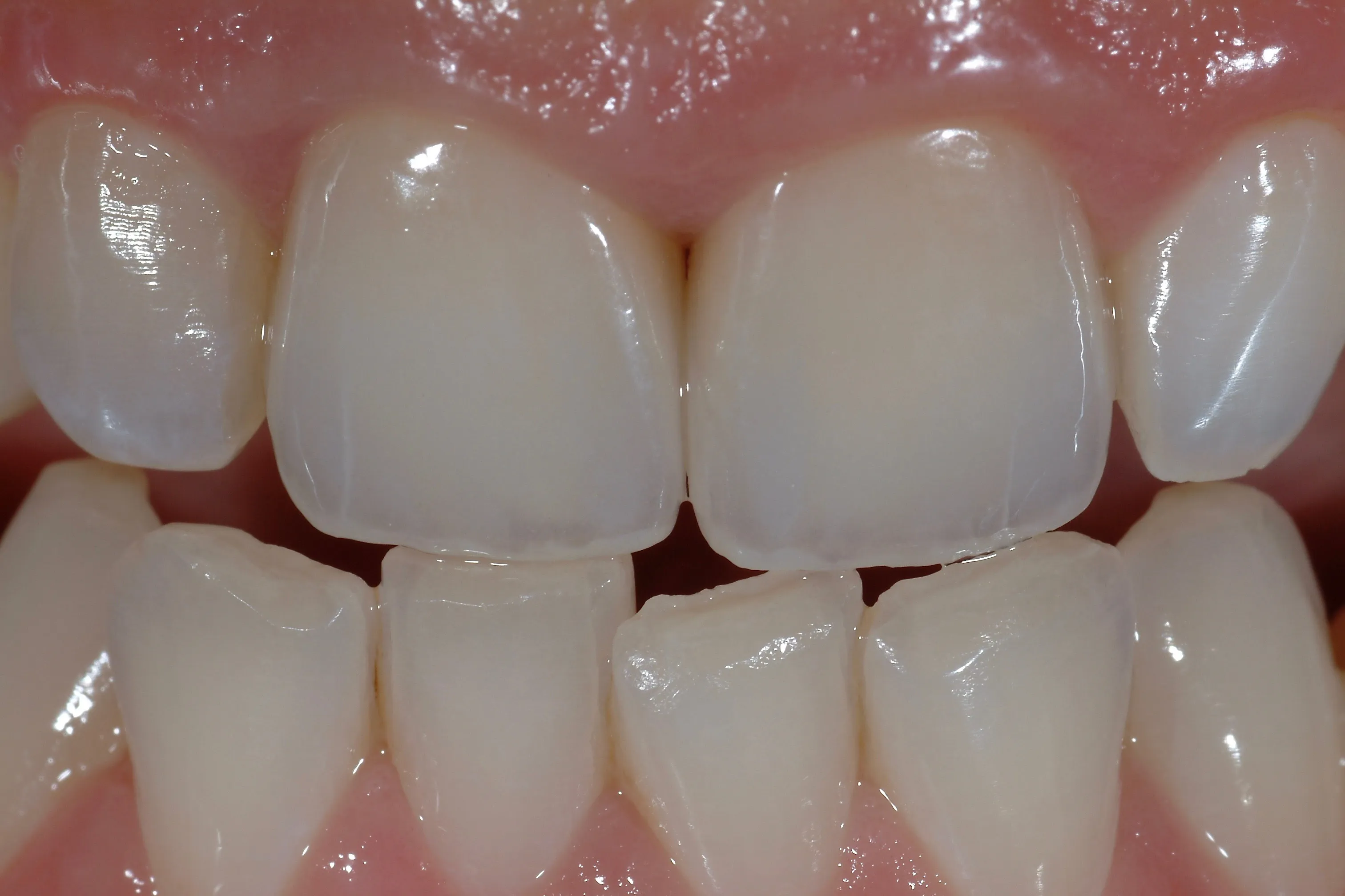 Sostituzione di vecchi restauri incongrui