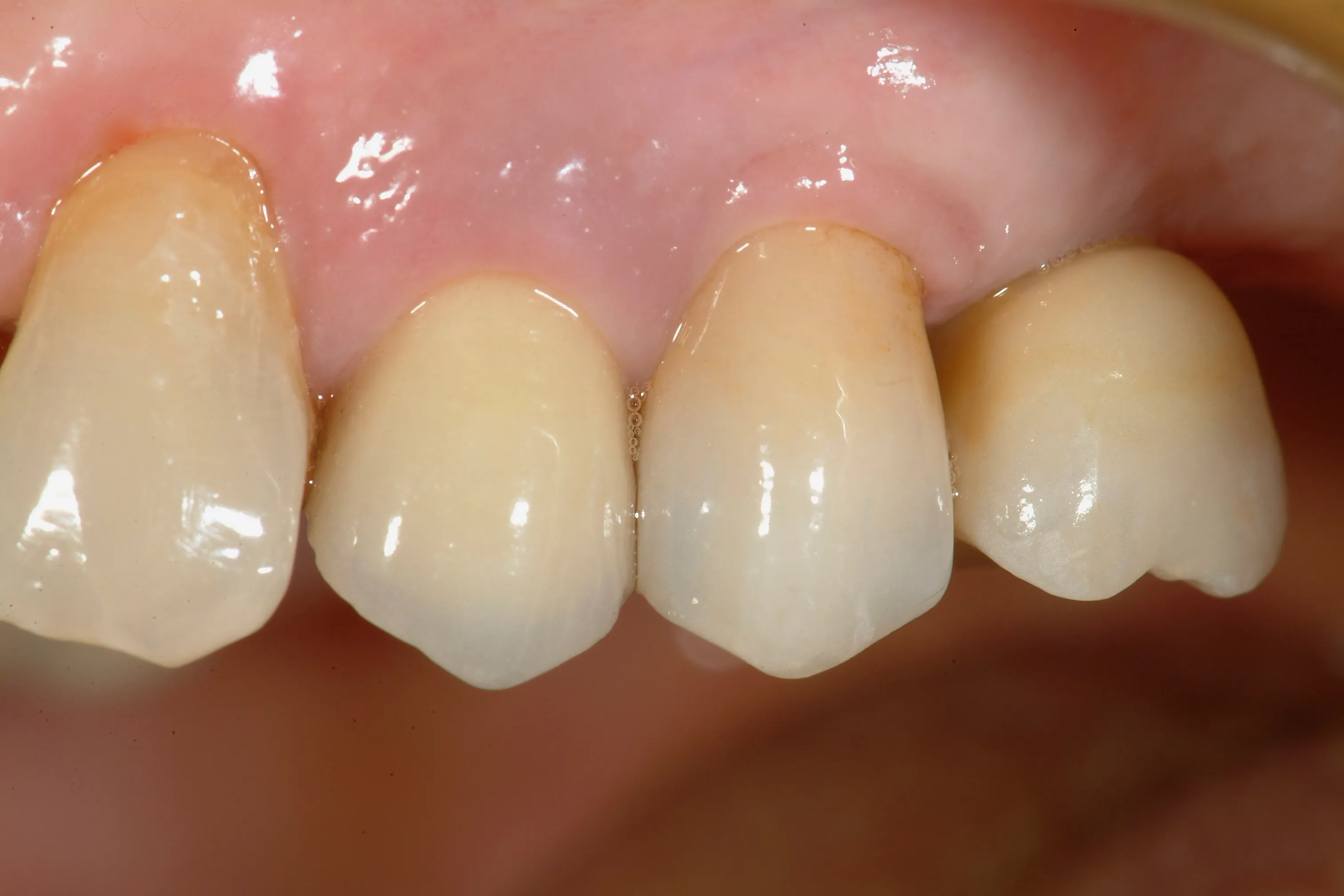 Riabilitazione implanto-protesica